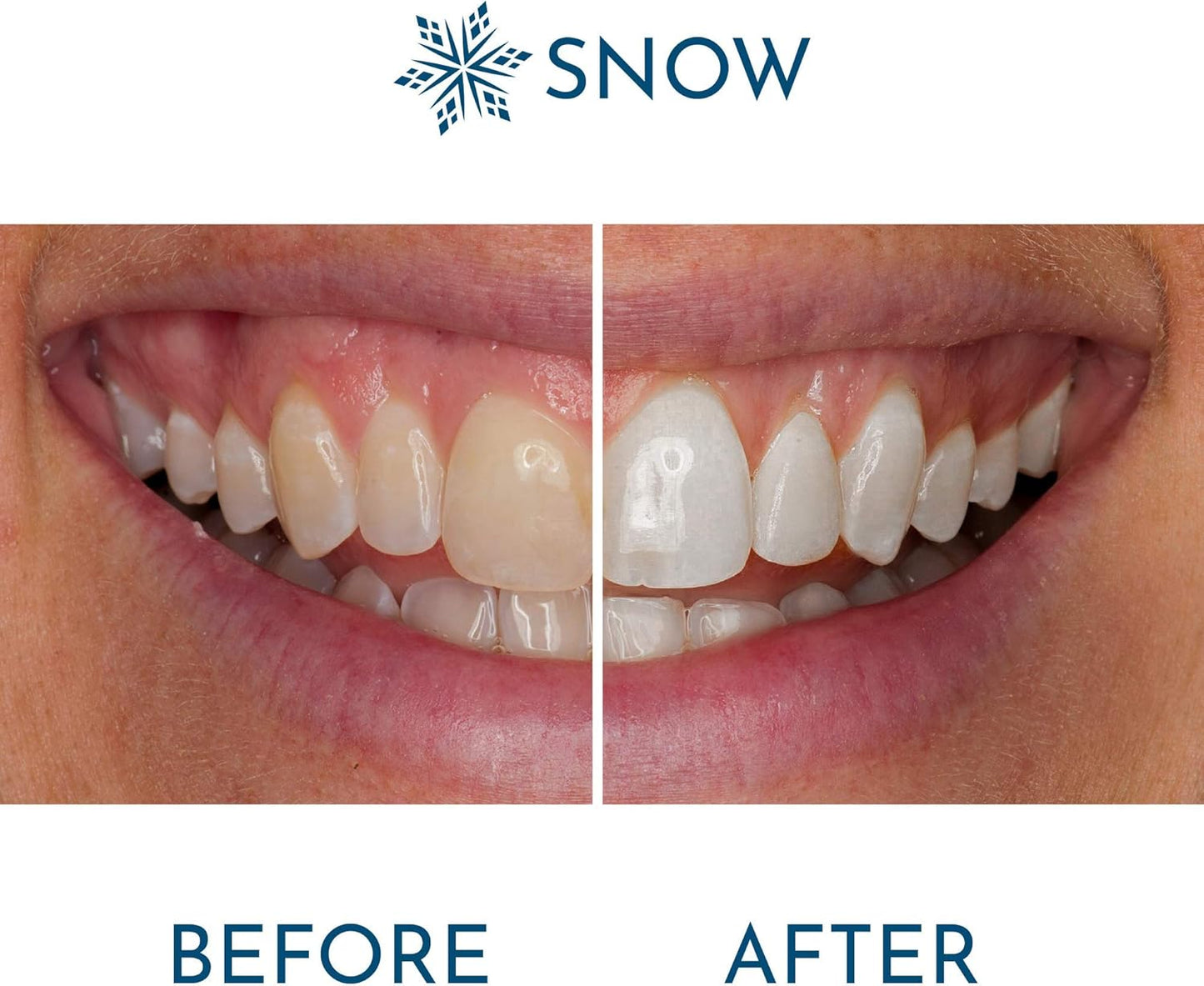 Snow Extra-Strength Teeth Whitening Pen, Enamel-Safe Tooth Whitening Pen for Sensitive Teeth, Teeth Whiteners for Oral Care, Stain Remover for Teeth That Visibly Whitens Tooth up to 8 Shades - 1 Pack