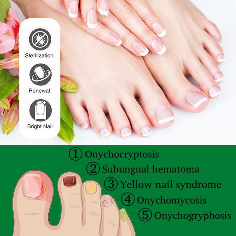 Ginger Nail Treatment, Support Nail Care, Ginger Cuticle Care Oil for Nails,Cuticle Serum for Nails Comfort Manicure